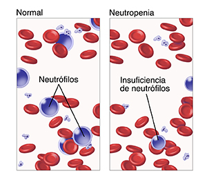 Muestra de sangre microscópica donde se observa una cantidad normal de neutrófilos. Muestra de sangre microscópica donde se observa muy poca cantidad de neutrófilos.