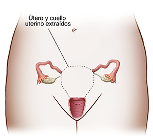 Vista frontal de una pelvis femenina mostrando los órganos reproductores. Una línea punteada delinea el útero y el cuello uterino para mostrar una histerectomía total.