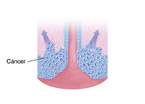 Corte transversal del cuello uterino con flechas que muestran la propagación de las células cancerosas.