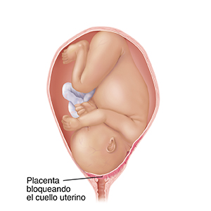 Vista frontal de un feto a término completo en un útero en los huesos pélvicos con la cabeza hacia abajo. La placenta bloquea el canal de parto donde se observa una placenta previa.