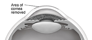 Cross section side view of front of cornea showing area of cornea removed by laser.