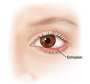 Front view of eye showing drooping of lower eyelid and ectropion.