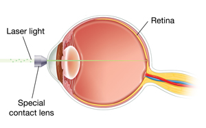 Side view of eye, showing special contact lens on front of eye. Laser light is focusing on inside back wall of eye.